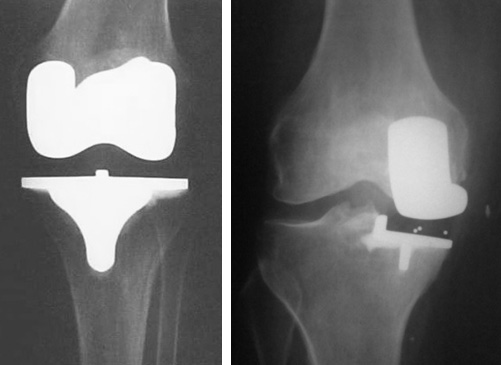 Radiografias de Artroplastia total e unicompartimental do joelho